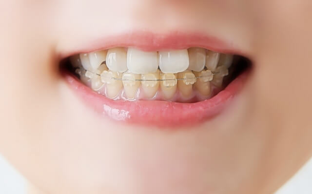 歯並び治療（矯正歯科）が原因で歯茎が下がるのはなぜ？